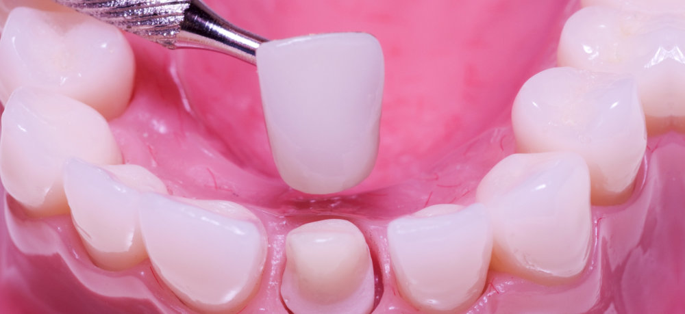 crowns Dental Implants