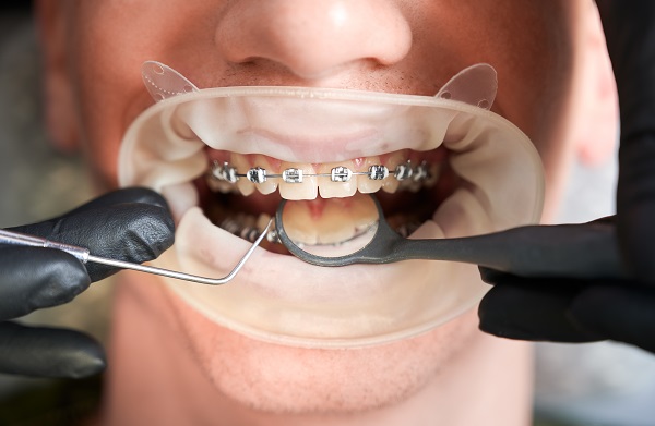 Dealing with the Reality of Increased Disease Risk with Braces