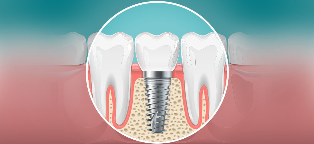 Dental Implants