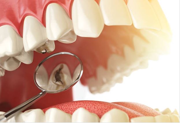 The Tooth Decay Process: How to Reverse it and Avoid a Cavity