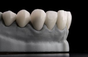 Ceramic dental veneers on artificial plastic jaw Dental Emergency