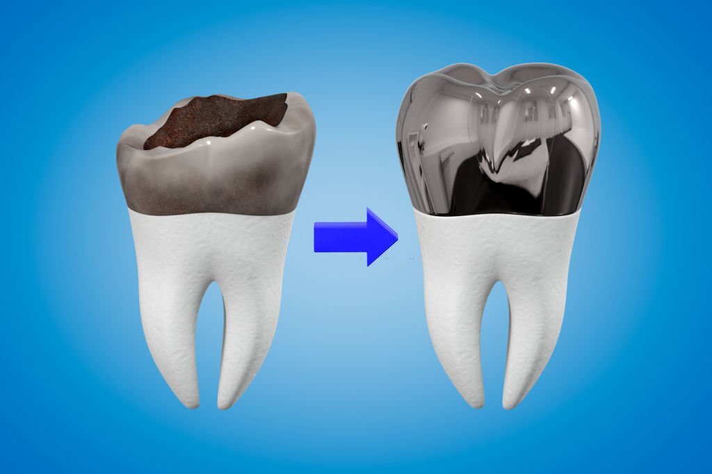 Dental Crowns - Tooth Crowns