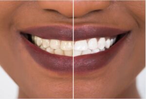 Teeth Whitening Medford & Somerville