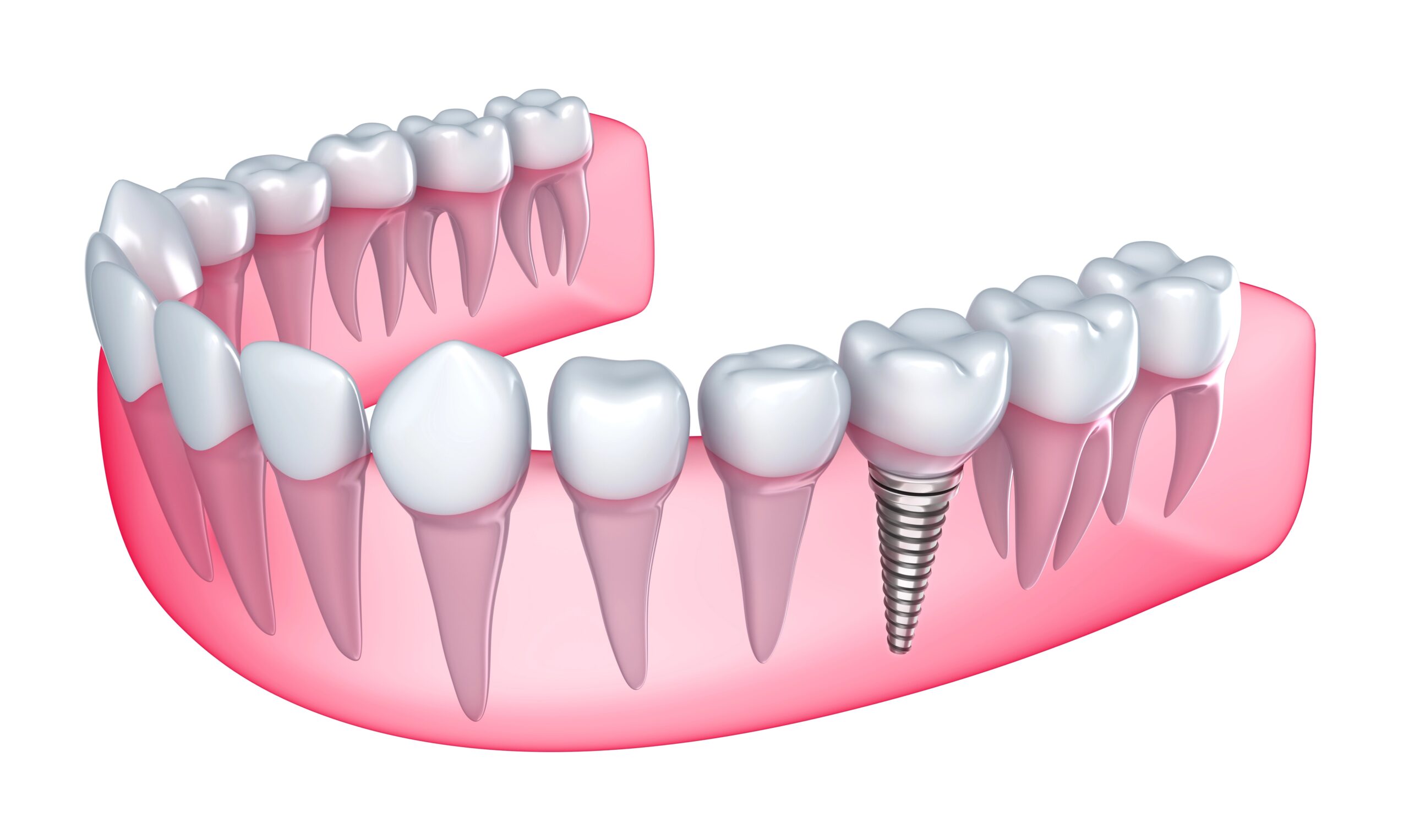 3D rendering of dental implants